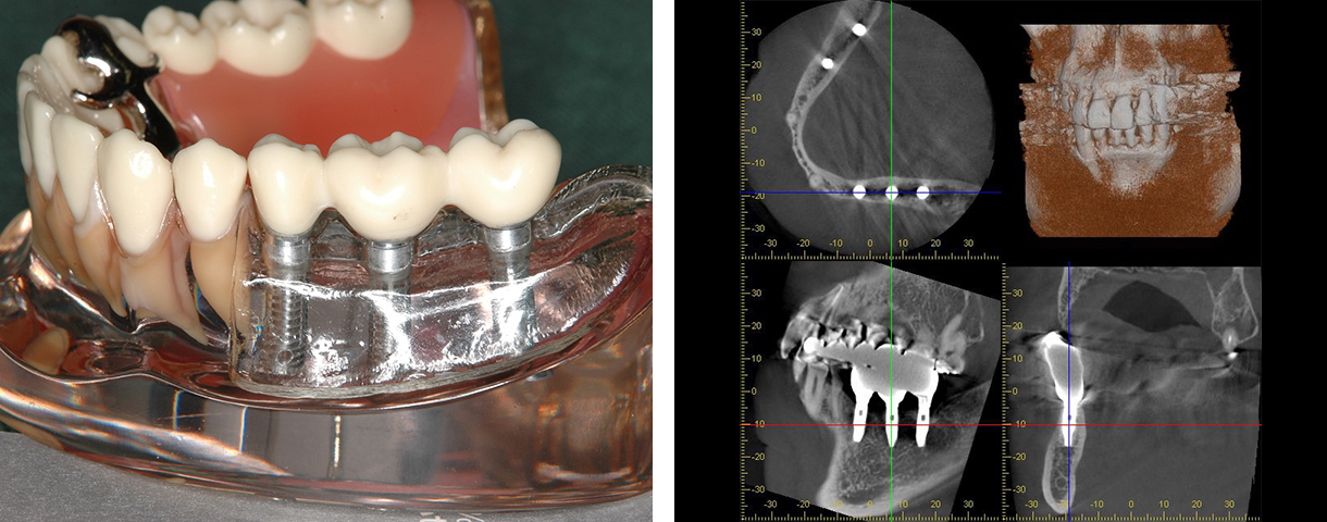 インプラント写真
