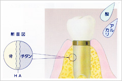 インプラントの材料