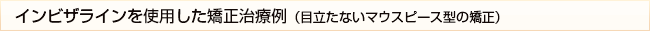 インビザラインを使用した矯正治療例（目立たないマウスピース型の矯正）